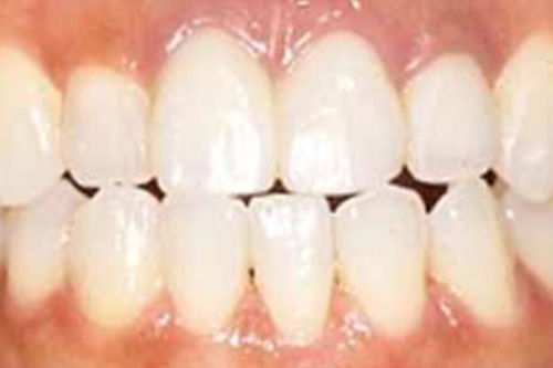 治療後写真：前歯がオールセラミック治療で美しくなりました