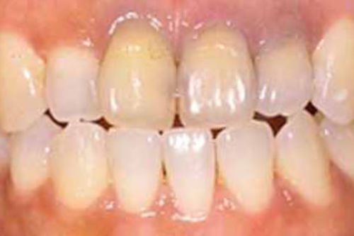 治療前写真：前歯2本が黄ばんでいる状態