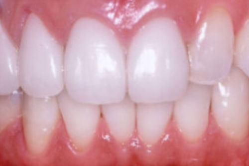 治療後写真：セラミック矯正により前歯が綺麗になりました