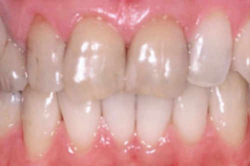 治療前写真：前歯同士に隙間が空いている状態