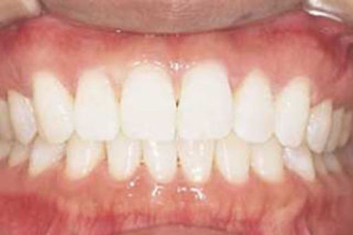 治療後写真：ホームホワイトニングで歯が白くなりました