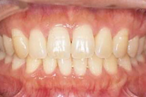 治療前写真：歯の黄ばみが目立っていました
