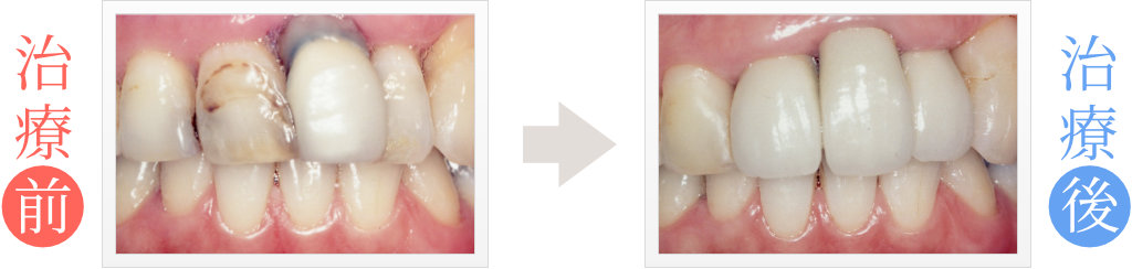 前歯3本の不適合をセラミック矯正