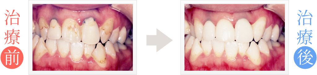 前歯3本をセラミック矯正治療で修復