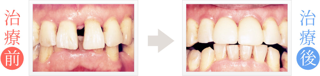 前歯の隙間をセラミック矯正治療で修復