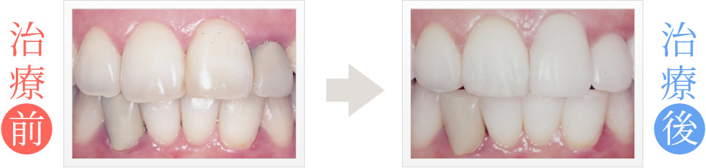 4本の前歯をセラミック矯正で修復