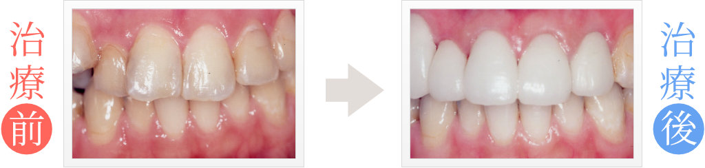 歯の黄ばみをセラミック矯正治療で修復