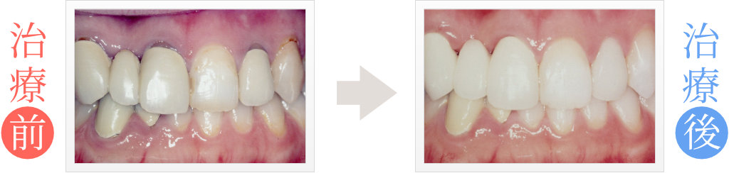 歯と歯茎の境にできた黒ずみをセラミック矯正で修復