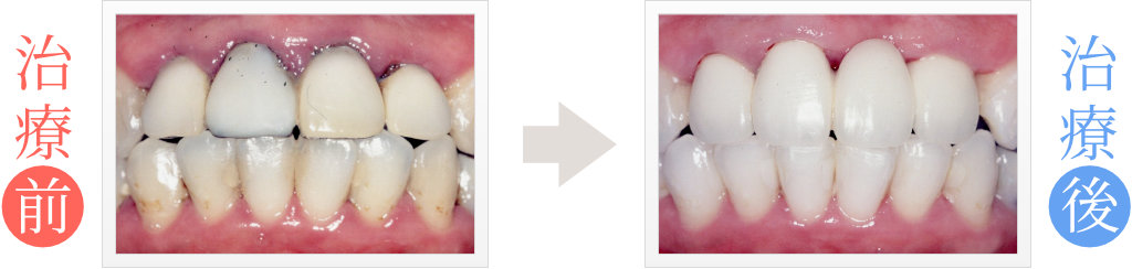 セラミック矯正（前歯4本）で歯の黒ずみや汚れを修復