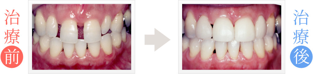 セラミック矯正で歯の隙間を修復