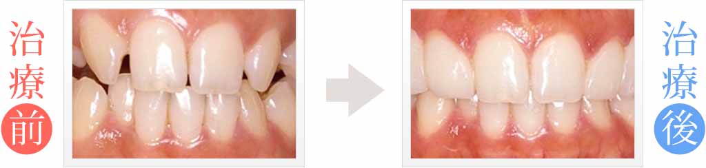 矯正とラミネートべニアで前歯の歪みを治療