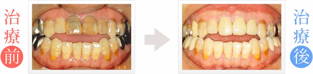 黒い前歯をオールセラミックス治療
