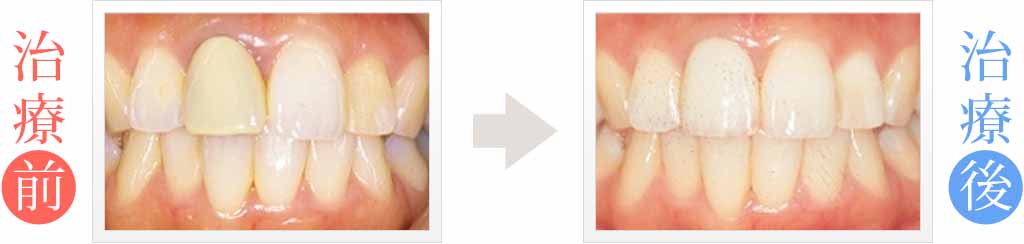 前歯の変色をセラミック治療