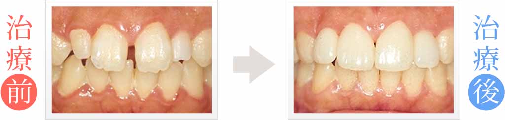 歯の隙間をラミネートベニアで審美治療