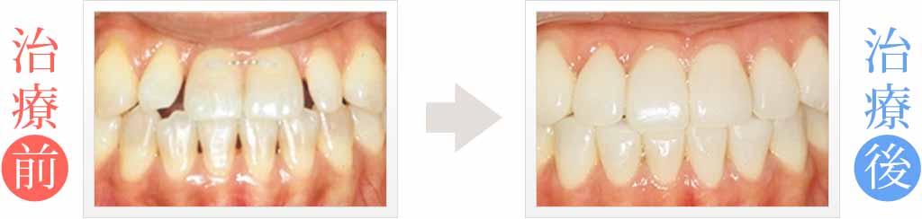 前歯の隙間と変色を審美歯科治療