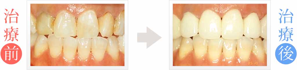 歯のガタガタと変色をオ－ルセラミックス治療