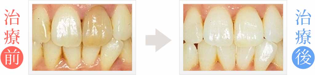 変色した歯をホワイトニング＆セラミック治療