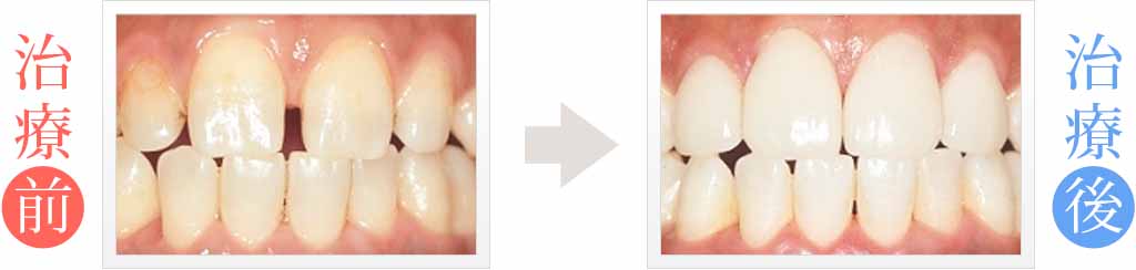 歯の隙間と変色をホワイトニング後にラミネートベニアで治療