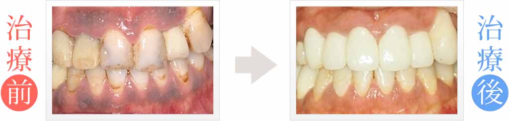 歯茎の黒ずみと詰め物の変色を審美治療
