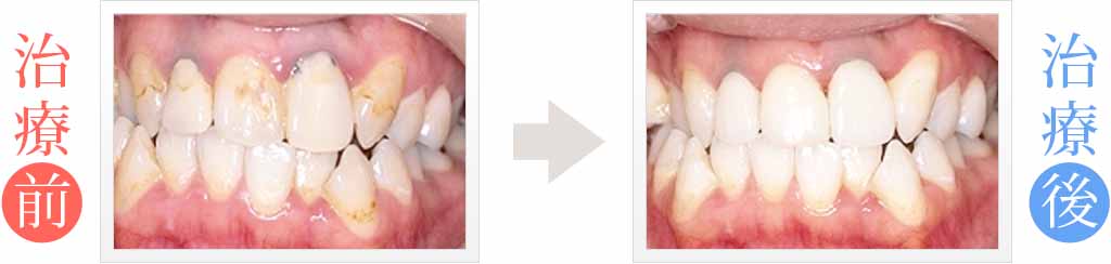 歯のホワイトニングとセラミック治療
