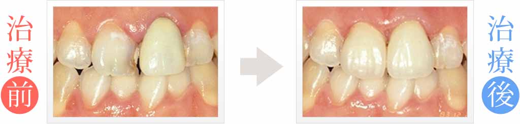 前歯のガタガタと審美障害の治療