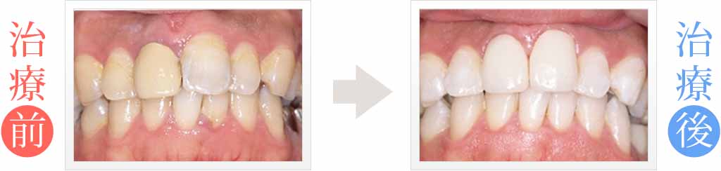 全体的な歯の黄ばみを白くする審美治療