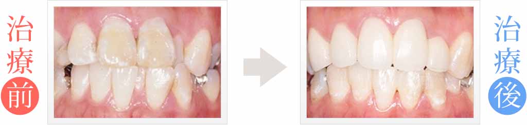 前歯のガタガタを部分矯正＆セラミック治療