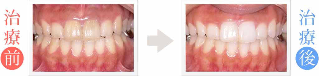前歯の黒ずみをオールセラミックス治療