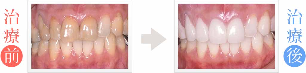 歯の汚れをホワイトニング＆審美歯科治療
