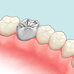 歯医者の銀歯治療