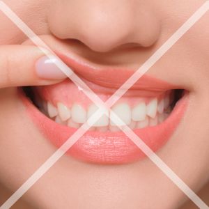 歯肉とセラミックの適合が不十分