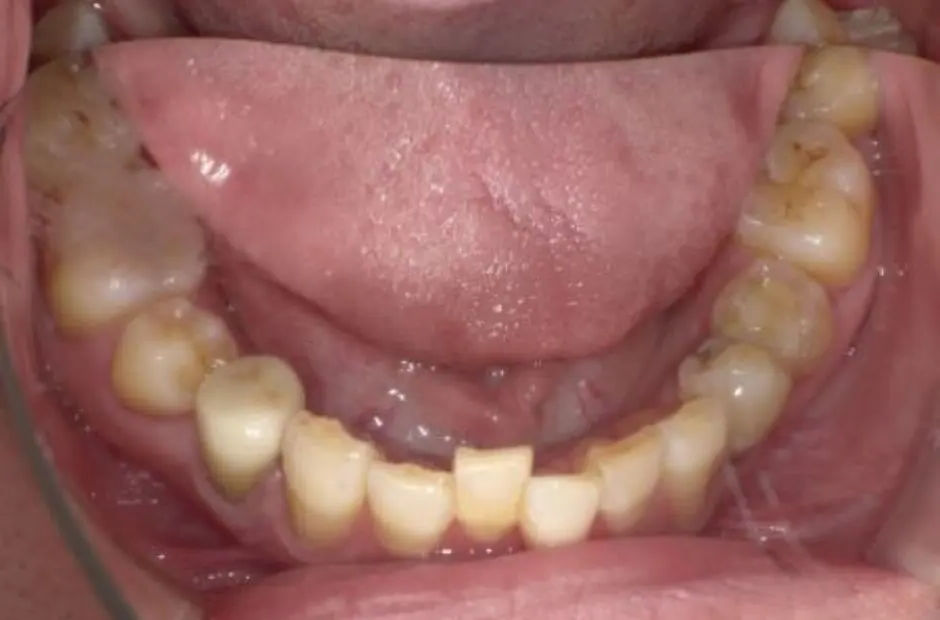 金属アレルギー治療の症例・治療後写真（銀歯1本）