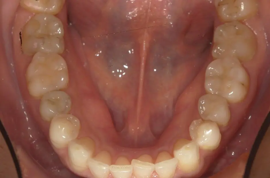 金属アレルギー治療の症例・治療後写真（銀歯7本）