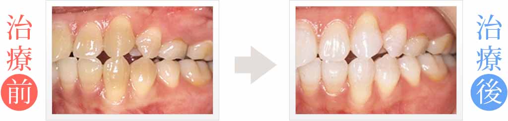 抗生物質による歯の変色をホワイトニング治療