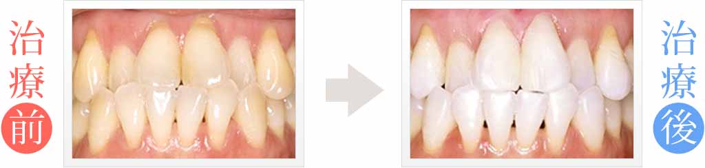 人から見られる全ての歯をホワイトニング治療