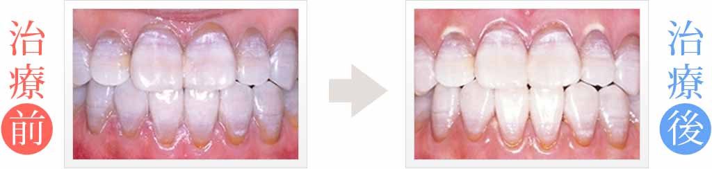 テトラサイクリンが原因の歯の黒ずみ治療