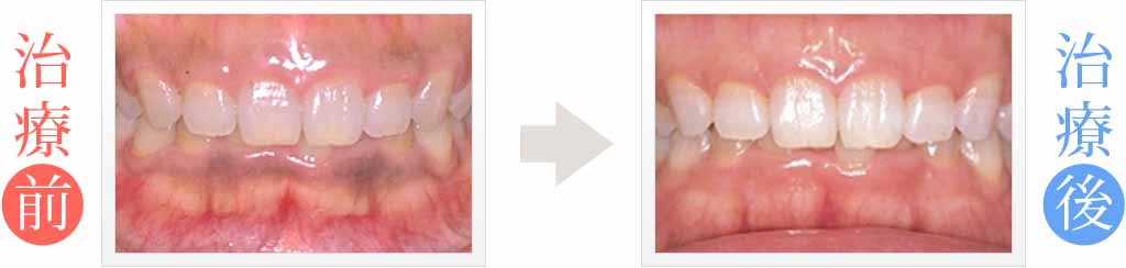 歯茎の黒ずみをホワイトニング治療
