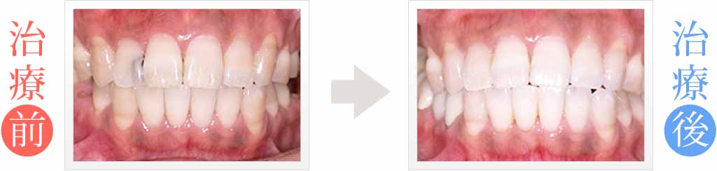 岡山市の歯医者で前歯12本をホワイトニング治療