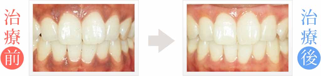 メラニン色素が原因の歯茎の黒ずみをホワイトニング治療
