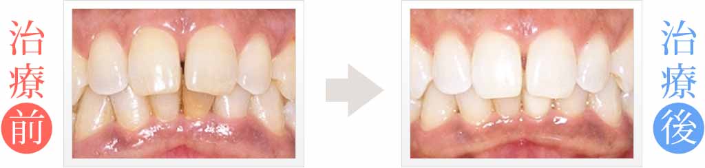 歯の黄ばみが目立つ前歯をホワイトニング