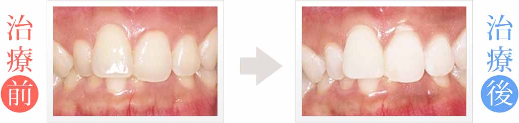 前歯12本のホワイトニング治療症例
