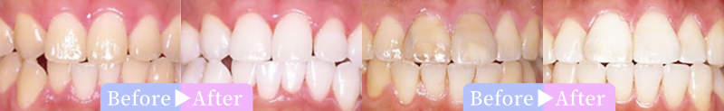 歯のホワイトニング症例（なかの歯科・矯正歯科クリニック）