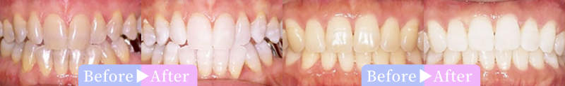 ホワイトニング歯科症例