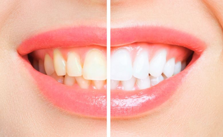 審美歯科やホワイトニングで第一印象が変わる